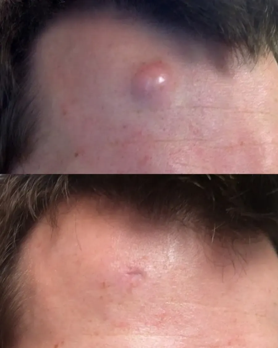 Dermoid Excision at Cinch Clinics